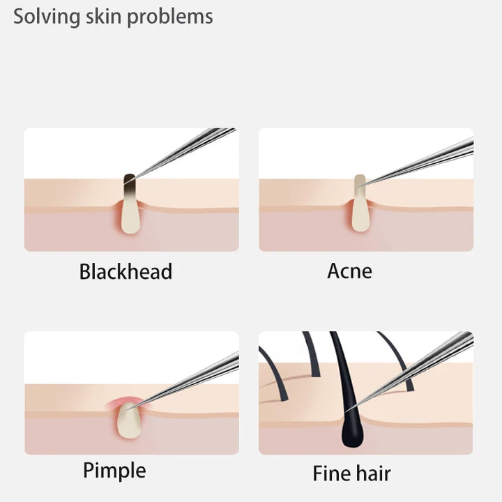 Acne Blackhead Removal Needles Stainless Steel Black Spot Blemish Pimple Removal Needle Deep Cleansing Tool Face Skin Care Kit